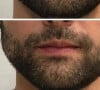Alok antes e depois da harmonização facial