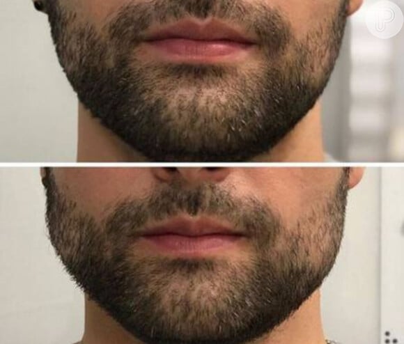 Alok antes e depois da harmonização facial