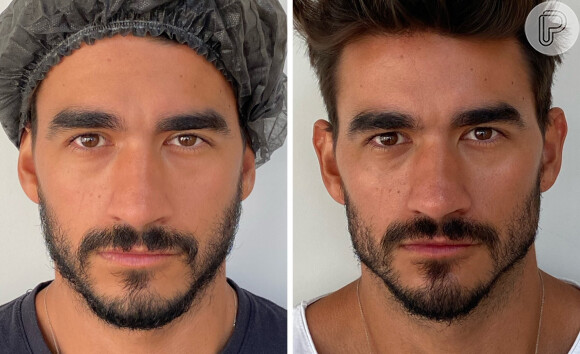 Gui Napolitano antes e depois da harmonização facial