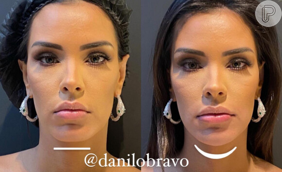 Ivy antes e depois da harmonização facial