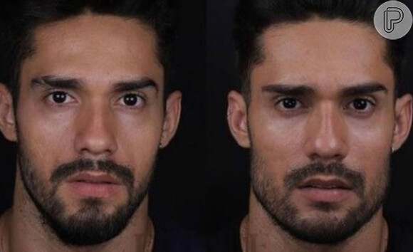 Bill Araújo antes e depois da harmonização facial