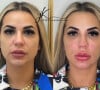 Deolane Bezerra antes e depois da harmonização facial
