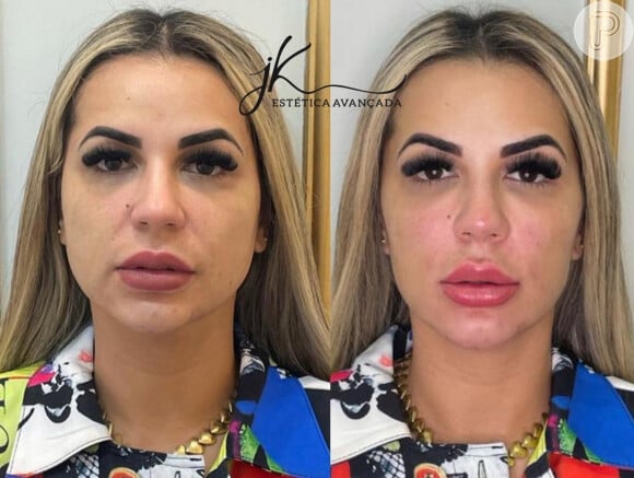 Deolane Bezerra antes e depois da harmonização facial