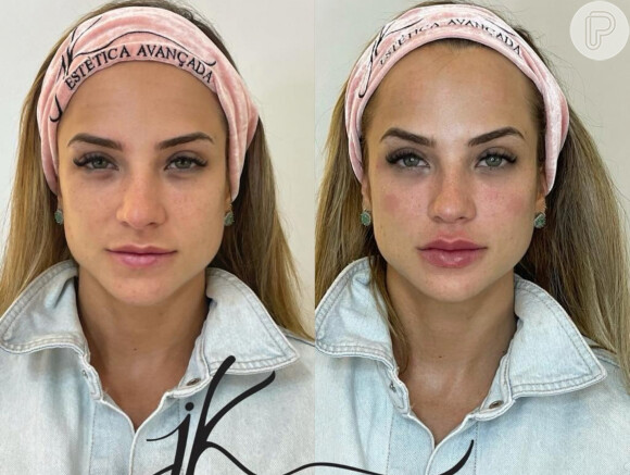 Gabi Martins antes e depois da harmonização facial