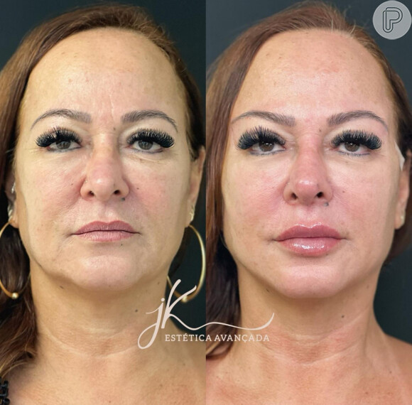 Nadine Gonçalves antes e depois da harmonização facial