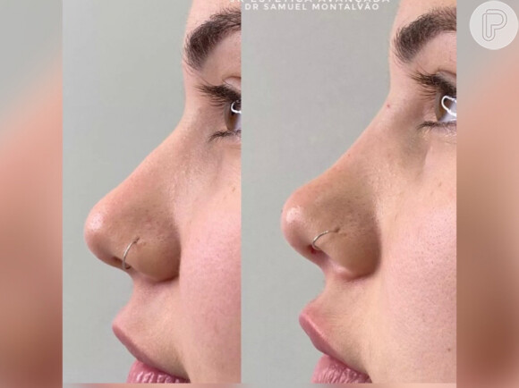 Virgínia Fonseca antes e depois da harmonização facial