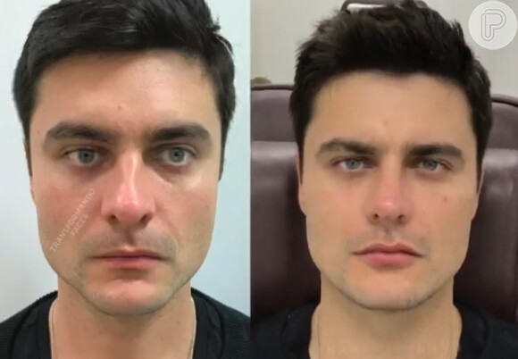 Guilherme Leicam antes e depois da harmonização facial