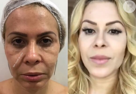 Joelma antes e depois da harmonização facial