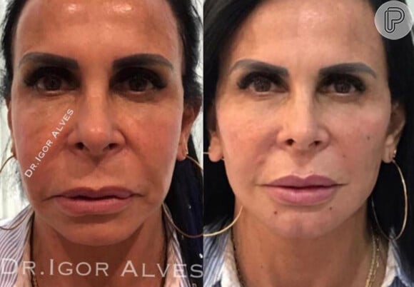 Gretchen antes e depois da harmonização facial