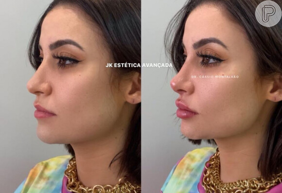 Bianca Andrade antes e depois da harmonização facial