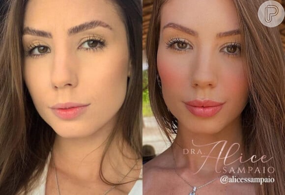Maria Lina antes e depois da harmonização facial