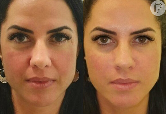 Graciele Lacerda antes e depois da harmonização facial