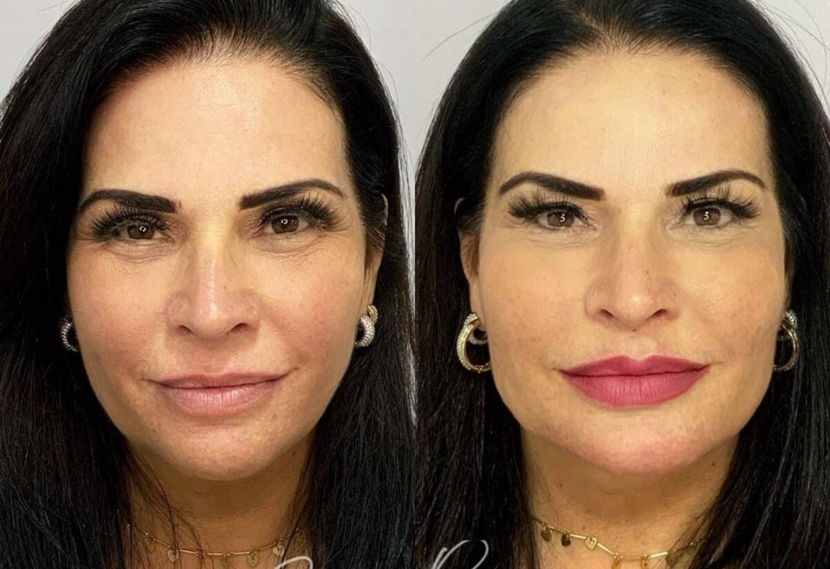 Foto: Solange Gomes antes e depois da harmonização facial - Purepeople