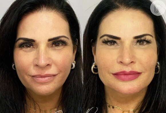 Solange Gomes antes e depois da harmonização facial