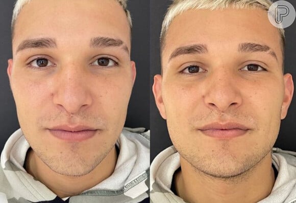 MC Gui antes e depois da harmonização facial