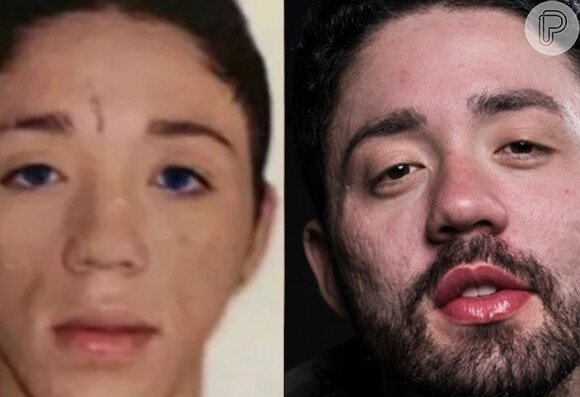 Rico Melquíades antes e depois da harmonização facial