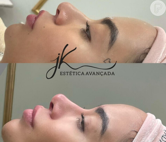 Rafaella Santos antes e depois da harmonização facial
