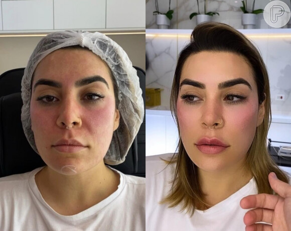 Naiara Azevedo antes e depois da harmonização facial