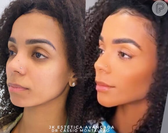 Brunna Gonçalves antes e depois da harmonização facial