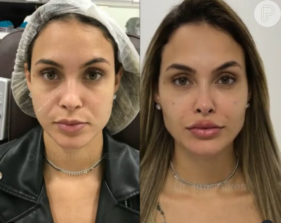 Sarah Andrade, do 'BBB 21', antes e depois da harmonização facial