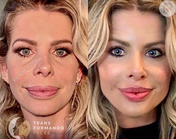 Karina Bacchi antes e depois da harmonização facial