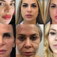 Deolane, Gretchen, Joelma, Gkay e mais: veja o antes e depois de famosos adeptos da harmonização facial!