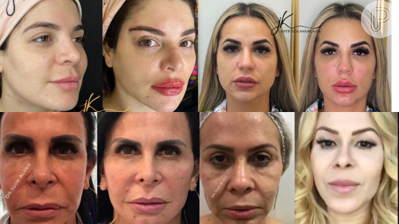 Fotos de famosos que fizeram harmonização facial: antes e depois! 