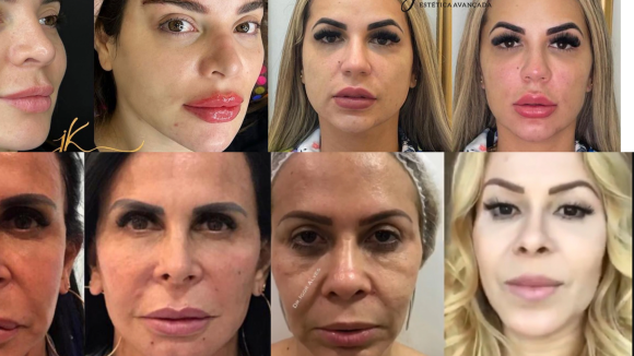 Deolane, Gretchen, Joelma, Gkay e mais: veja o antes e depois de famosos adeptos da harmonização facial!