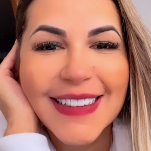 Antes e depois de Deolane Bezerra sem preenchimento labial