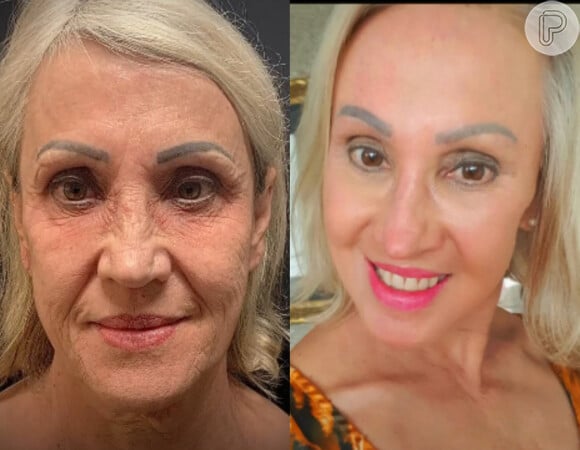 Peeling de fenol: antes e depois de tratamento estético viraliza no Tik Tok e médico detalha cuidados