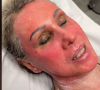 Peeling de fenol pode deixar o rosto avermelhado no pós-procedimento