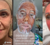 O peeling de fenol protagoniza um vídeo viral no Tik Tok: antes e depois de paciente teve mais de 25 milhões de visualizações
