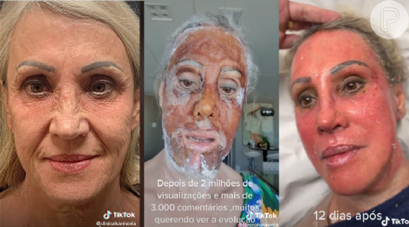 O peeling de fenol protagoniza um vídeo viral no Tik Tok: antes e depois de paciente teve mais de 25 milhões de visualizações