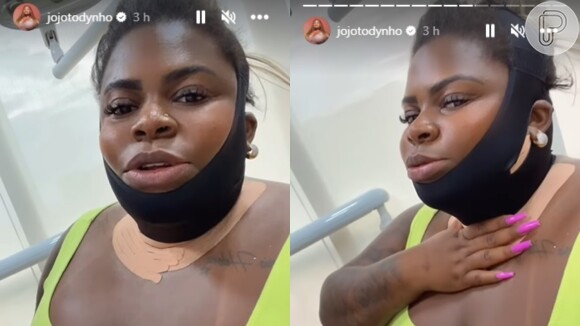 Jojo Todynho mostrou o rosto imobilizado após o procedimento nas redes sociais