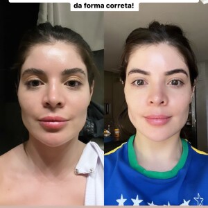 Gkay mostra antes e depois de retirar o preenchimento facial