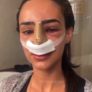 Bruna Biancardi exibiu o processo antes, durante e depois da recuperação da rinoplastia