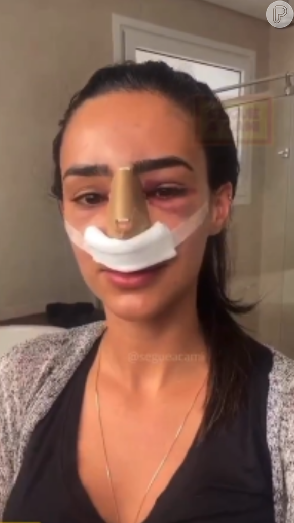 Bruna Biancardi exibiu o processo antes, durante e depois da recuperação da rinoplastia