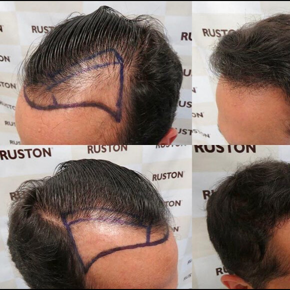 Thammy Miranda passou por transplante de cabelo