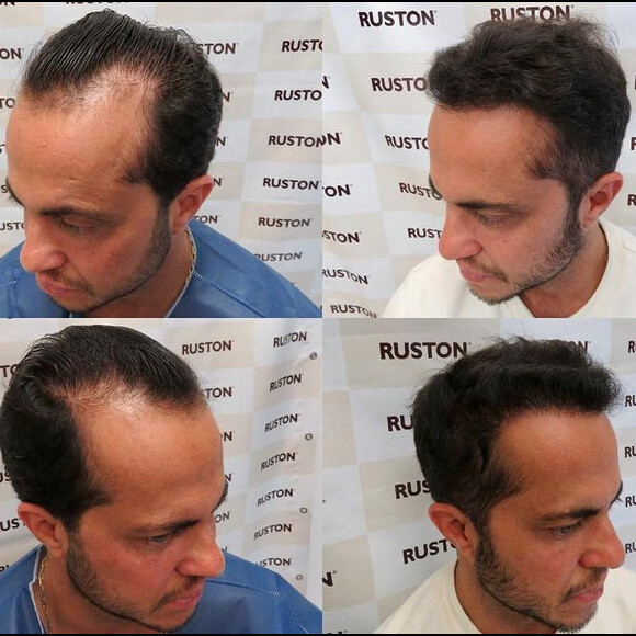 Thammy Miranda mostrou antes e depois de transplante capilar