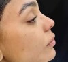 Brunna Gonçalves realizou uma nova harmonização facial neste ano