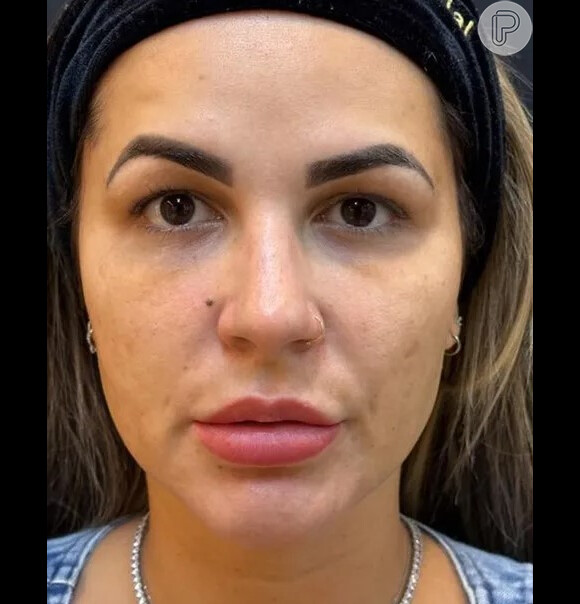 Deolane Bezerra também resolveu fazer harmonização facial outra vez em 2023