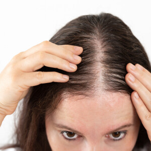 Alopecia pode ser causada dependendo de como a mulher cuida ou usa o cabelo