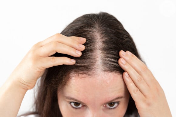 Alopecia pode ser causada dependendo de como a mulher cuida ou usa o cabelo