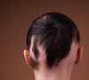 O uso de megahair, produtos químicos e até penteados podem causar a alopecia por tração