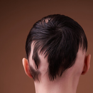 O uso de megahair, produtos químicos e até penteados podem causar a alopecia por tração