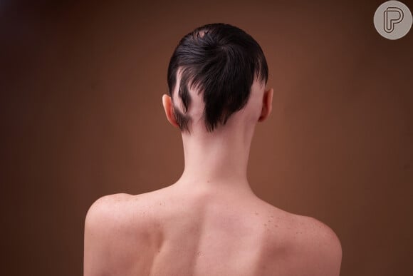 O uso de megahair, produtos químicos e até penteados podem causar a alopecia por tração