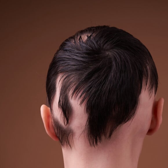 O uso de megahair, produtos químicos e até penteados podem causar a alopecia por tração