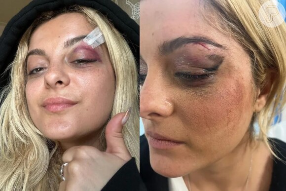 Bebe Rexha ficou com o olho roxo após agressão de fã