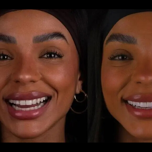 Confira o antes e o depois de Brunna Gonçalves após novo procedimento estático
