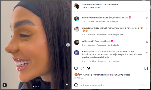 Brunna Gonçalves no Instagram foi elogiada por seu novo procedimento estético